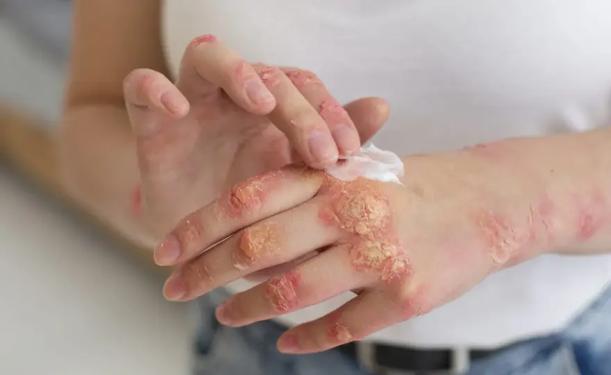 Psoriasis en las manos - señales, cuidados y tratamientos