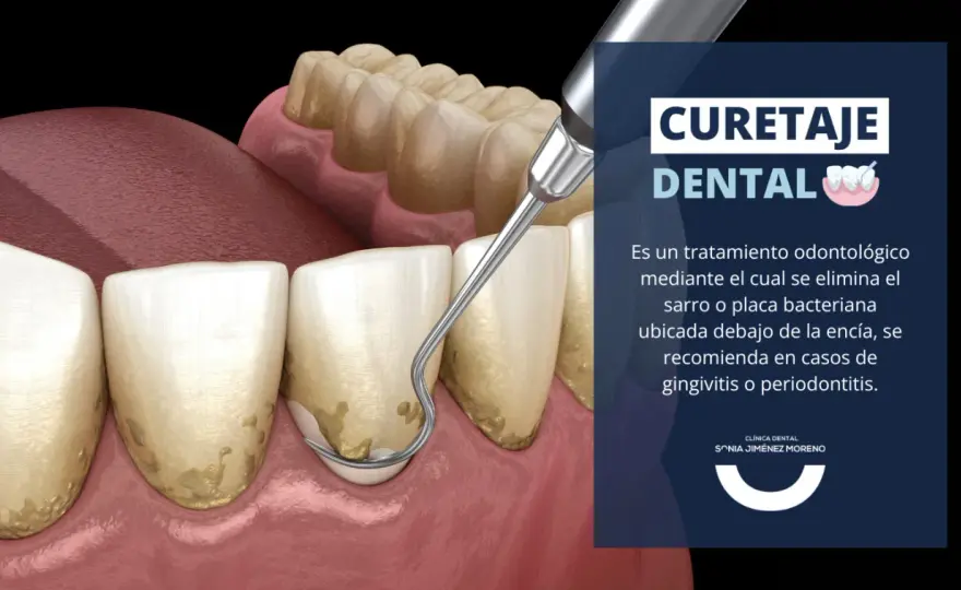 Limpieza periodontal, cuándo se necesita y cuánto cuesta