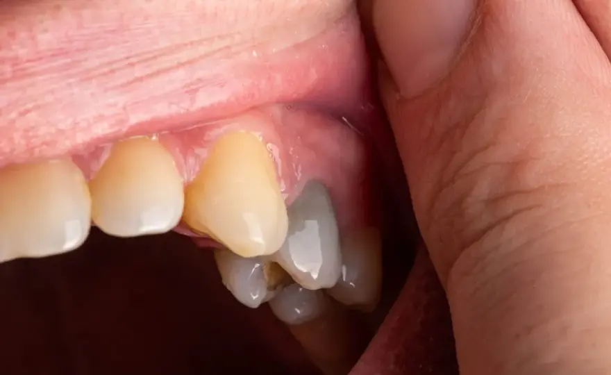 Szary ząb - Przyczyny i leczenie. Kiedy do dentysty?