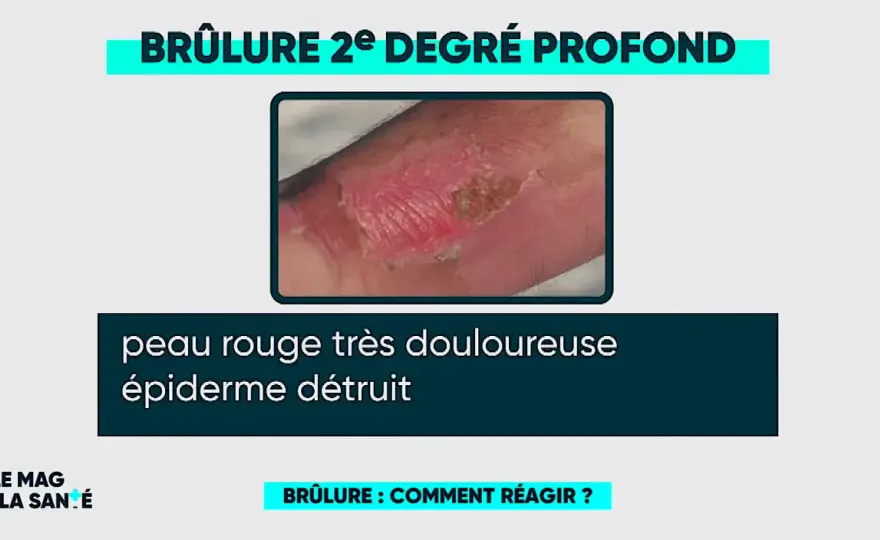 Brûlure à l’eau bouillante - quel degré et que faire ?