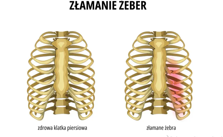 Złamane żebro - co robić? Rozpoznanie, leczenie, powrót.