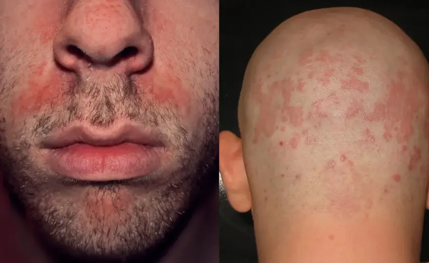 Dermatite seborroica del viso - sintomi, cure e recidive