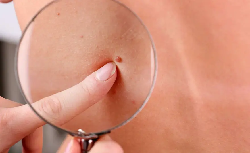 Angiomas Rubí - Puntos Rojos en la Piel - ¿Son peligrosos?