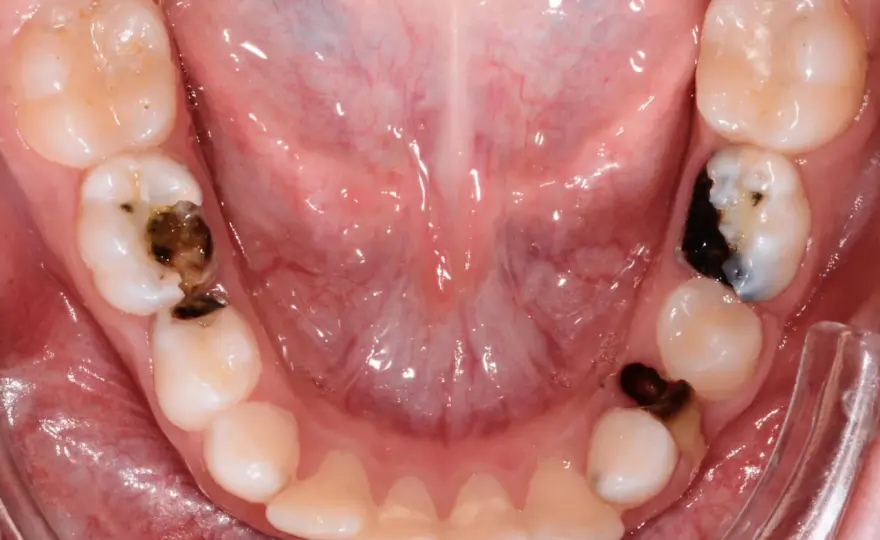 Carie nei denti da latte, perché curarli e come prevenirla