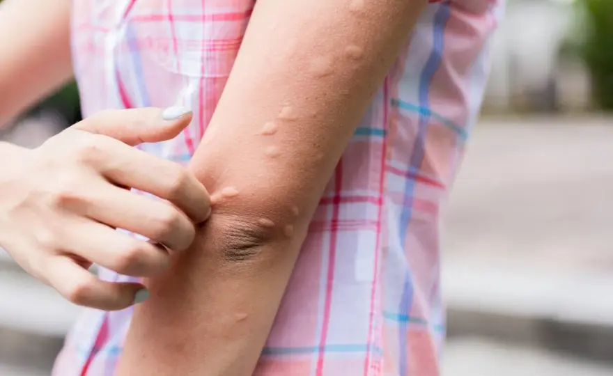 Brote en la piel - ¿Qué lo causa y cuándo ir al médico?