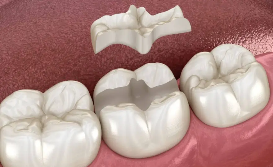Incrustación cerámica dental, cuándo conviene y cuánto cuesta