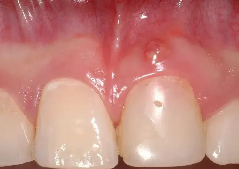 Zapalenie dziąseł u dziecka: Szybka ulga i kiedy do dentysty?