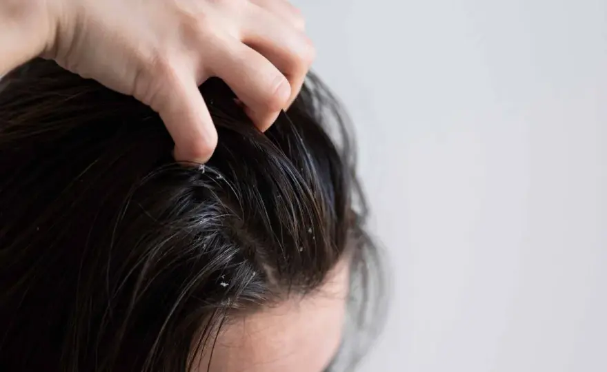 Cómo hidratar el cuero cabelludo sin empeorar la irritación