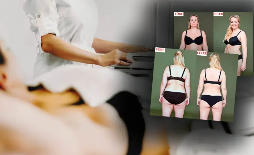 Fettfrysning överarmar - Vad du behöver veta om CoolSculpting