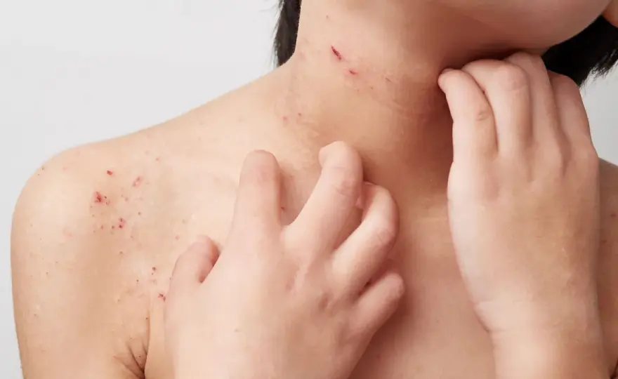 Pusteln bei Neurodermitis - Was tun & wann zum Arzt?