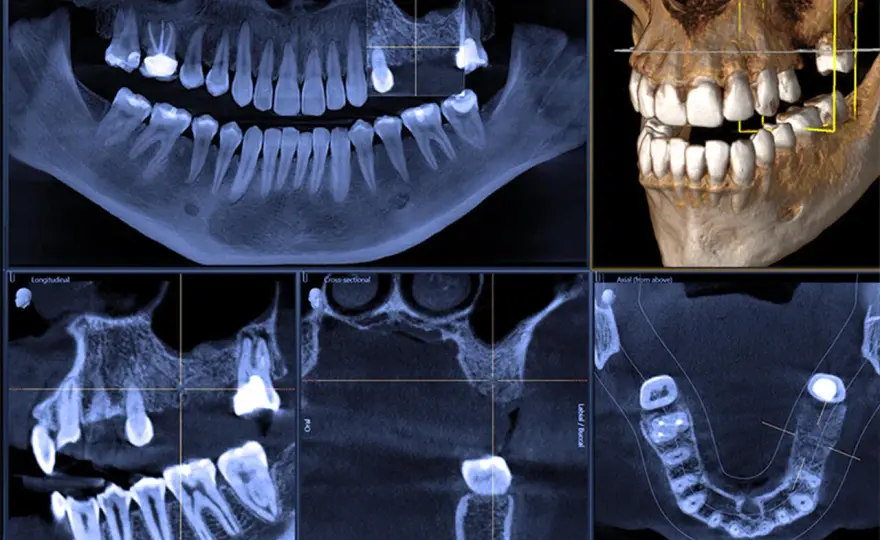 CBCT w stomatologii - Kiedy tomografia 3D ma sens?