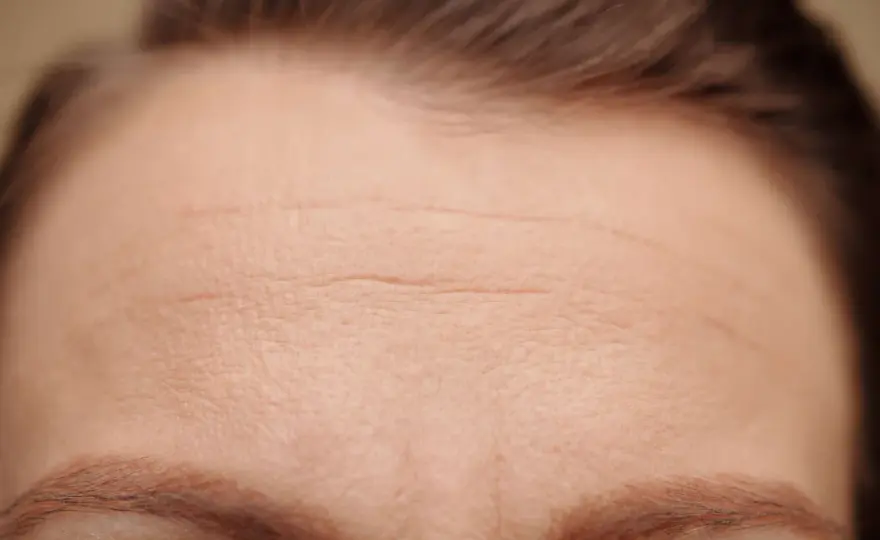 Botox i pannan - Allt du behöver veta innan du bokar
