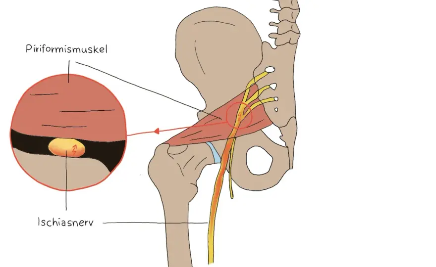 Piriformis-Syndrom erkennen und was wirklich hilft