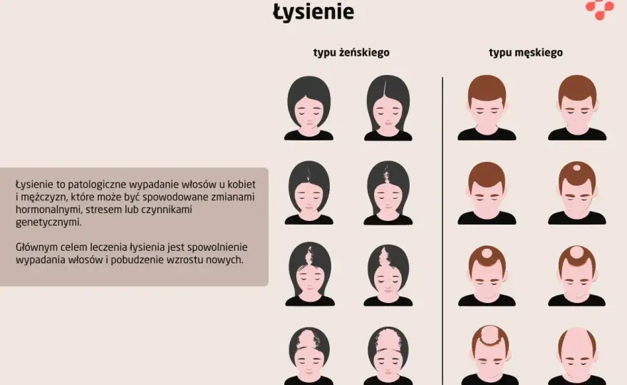 Łysienie z tyłu głowy - Przyczyny i skuteczne rozwiązania