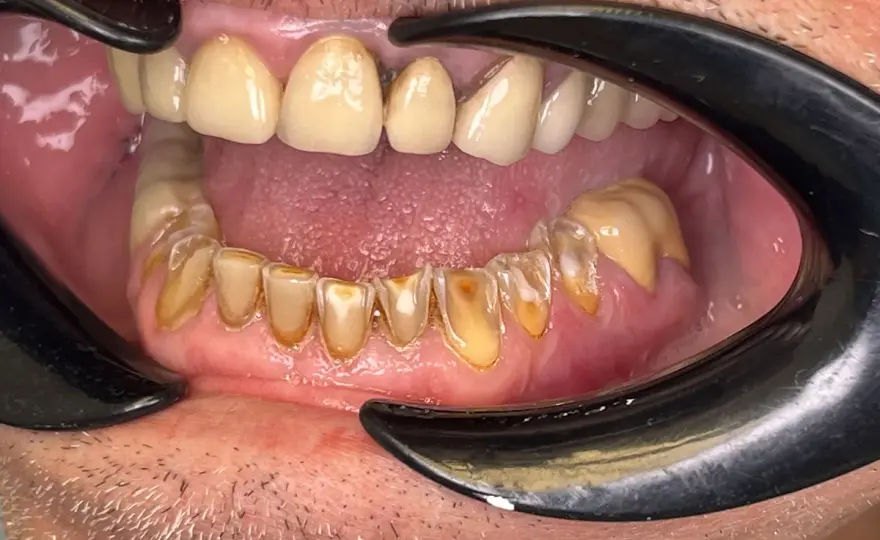 Abrasión dental - causas, diferencias y cuándo restaurarla