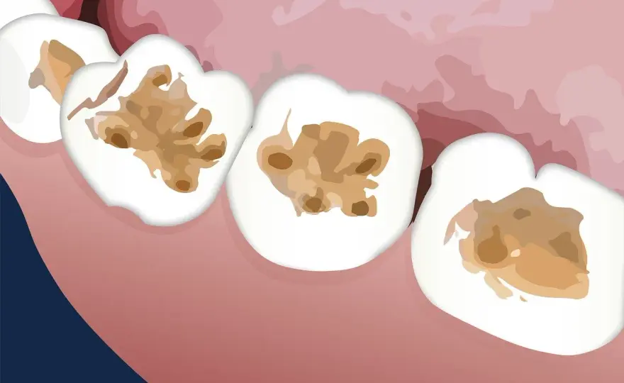 ¿Caries en dentina? Cuándo basta un empaste y cuándo no