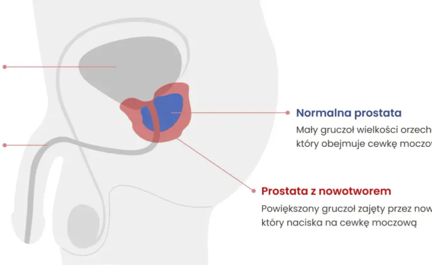 Choroba prostaty objawy - jak je rozpoznać i uniknąć powikłań