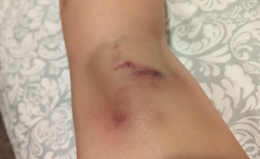 Siniaki po pole dance - Jak ich unikać i kiedy się martwić?