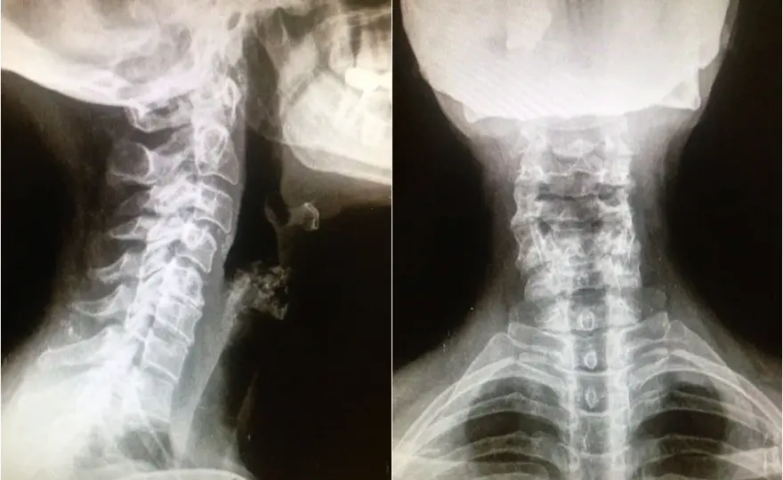 Síntomas de artrosis cervical grave: identifica el dolor y la debilidad