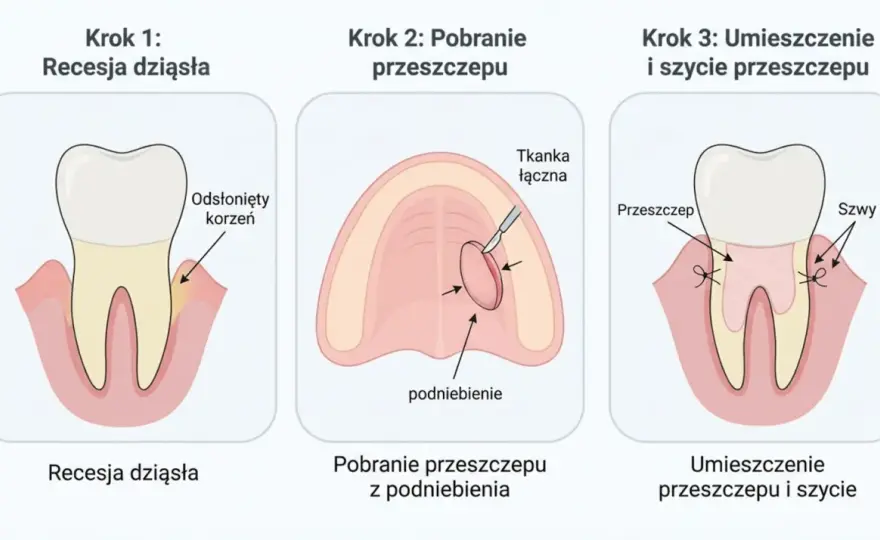 Przeszczep dziąsła z podniebienia - czy to rozwiązanie dla Ciebie?