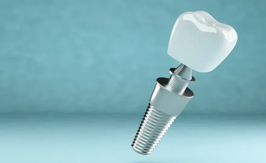 Odrzucenie implantu zęba po jakim czasie? Poznaj kluczowe czynniki