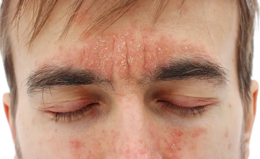 Dermatitis zu Hause beruhigen - was wirklich hilft