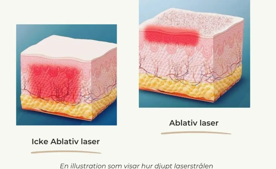 Koldioxidlaser - Allt du behöver veta innan du bokar