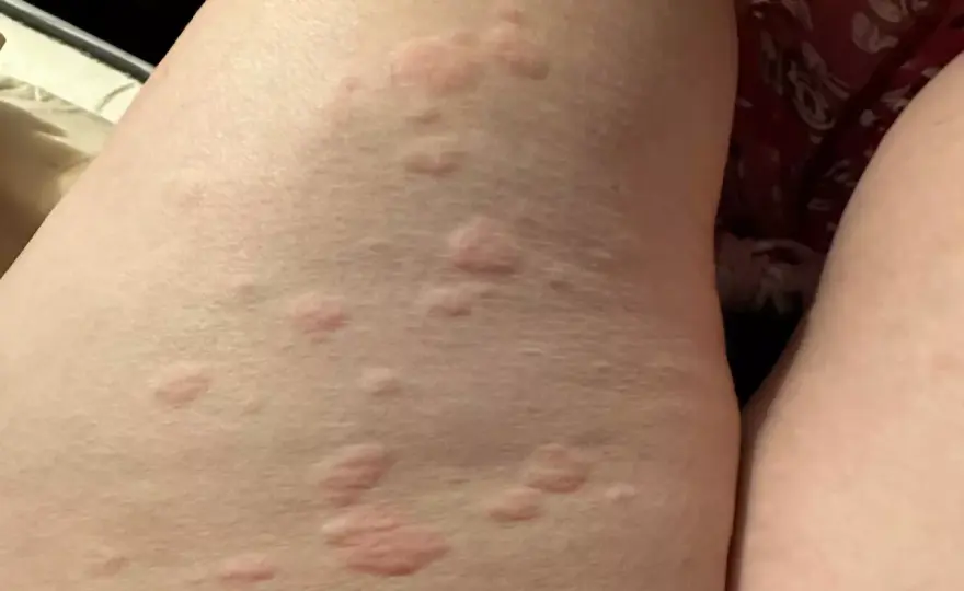 Orticaria post-infettiva - Riconoscila e agisci correttamente