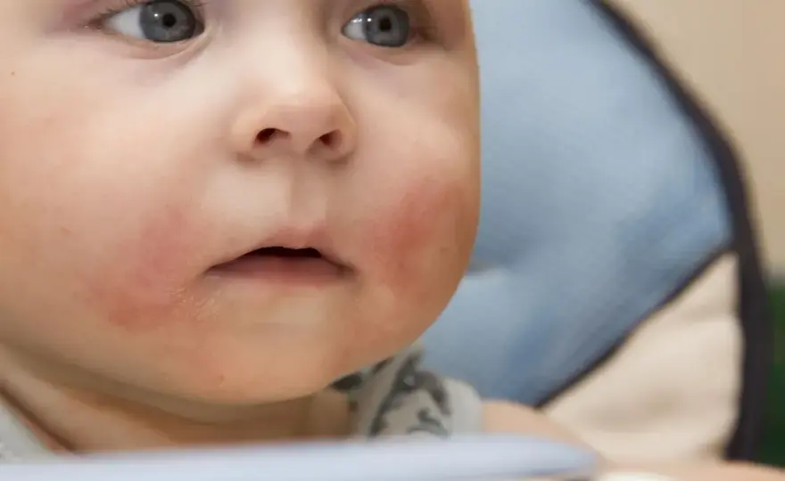 Gluten a zmiany skórne na twarzy - Alergia czy celiakia?