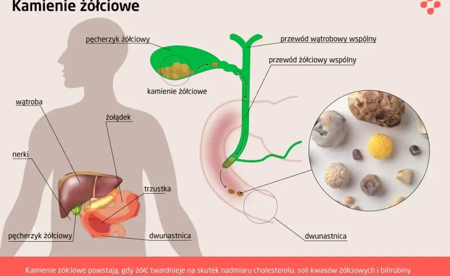 Kamica żółciowa - objawy, leczenie i dieta. Odmień swój ból!