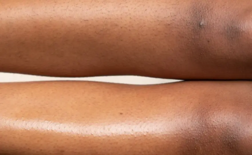 Eingewachsene Haare: Ursachen, Soforthilfe & Vorbeugung für glatte Beine