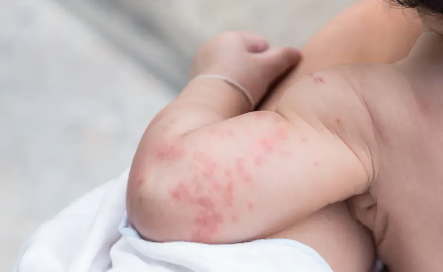 Dermatite atopica nel neonato - primi segnali e cosa fare