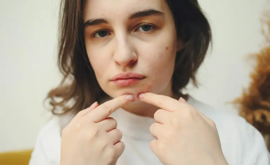 Retinol na trądzik - Komu faktycznie pomaga i jak go stosować?