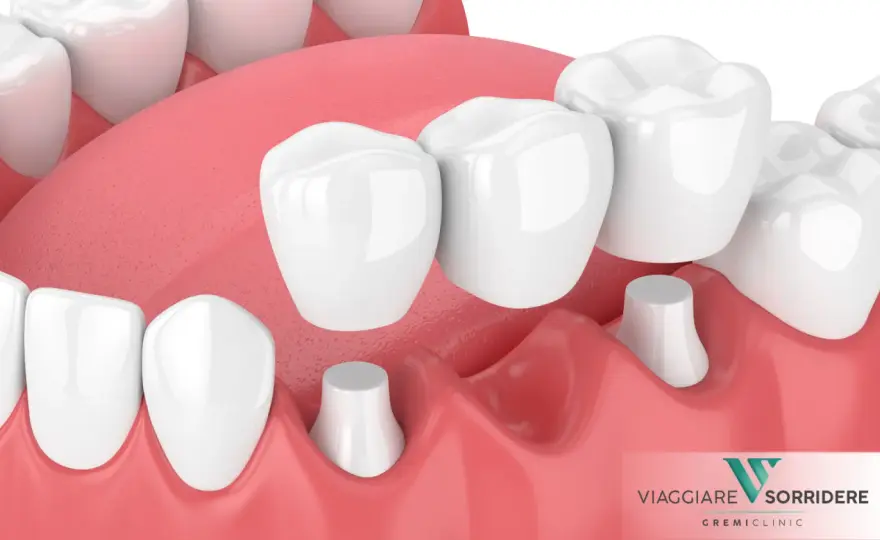 Corona su dente devitalizzato - quando serve davvero