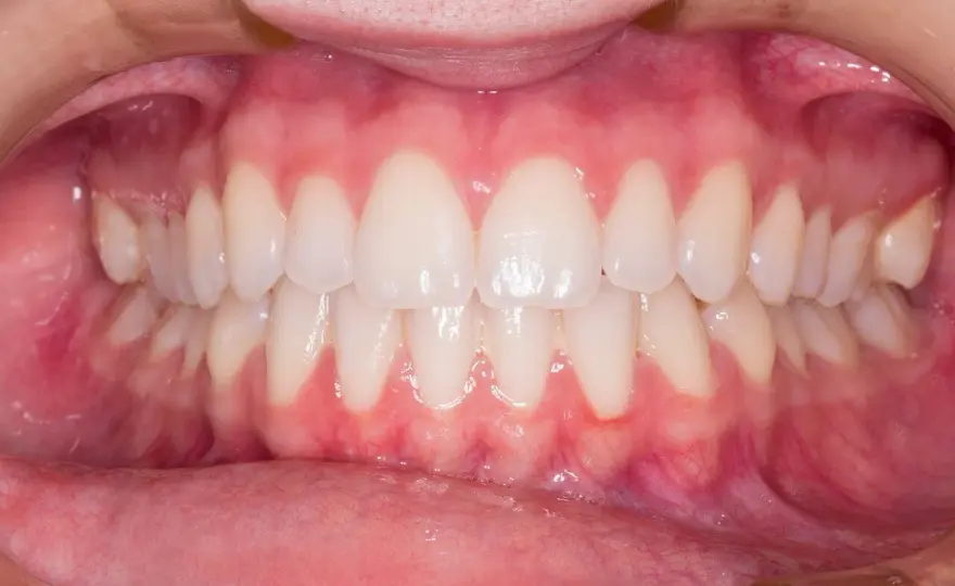 Gengive che sanguinano? Cause e quando andare dal dentista
