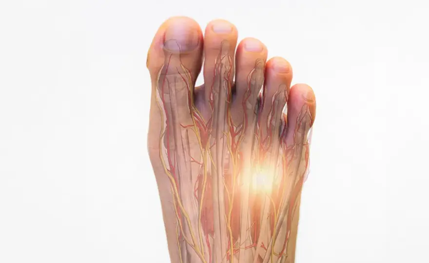 Morton-Neurom: Schmerz lindern – Hausmittel & Schuhe