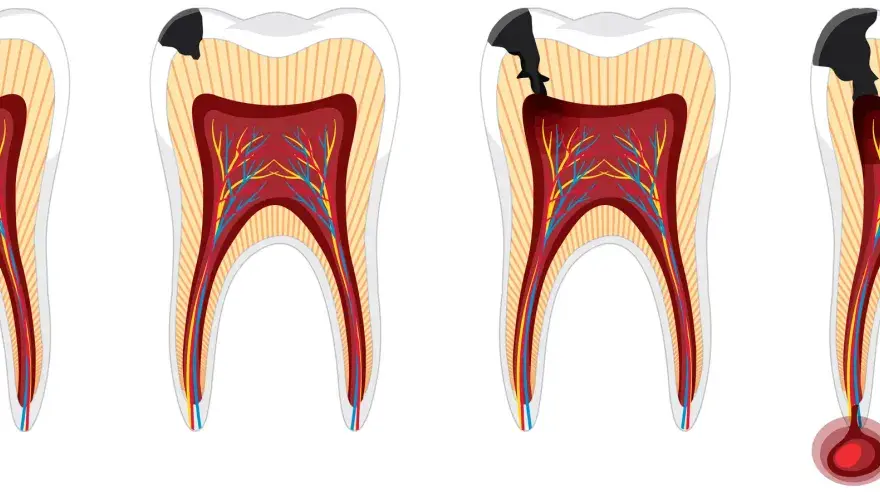 Pulpitis en una muela - síntomas y tratamientos