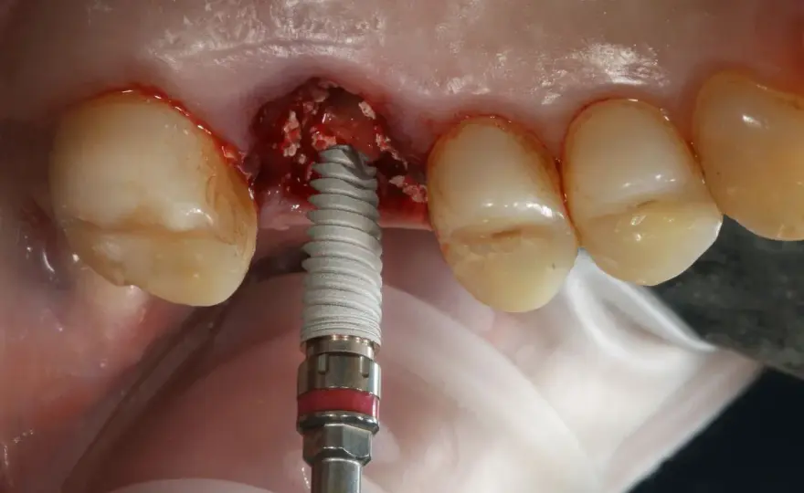 Fumare dopo impianto dentale - Rischi e tempi di attesa