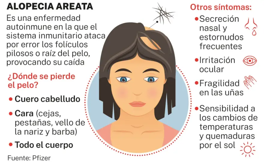 Alopecia areata en mujeres - ¿Qué hacer y cómo recuperarse?