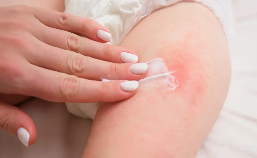Arrossamento tra i glutei, cosa fare e quando sentire il pediatra