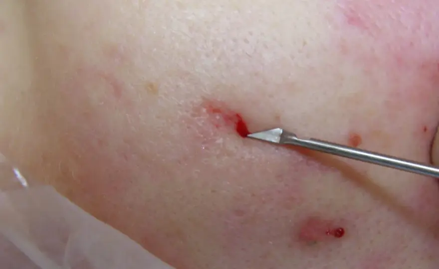 Subcision - Jämnare hud vid ärr & celluliter? Så fungerar det