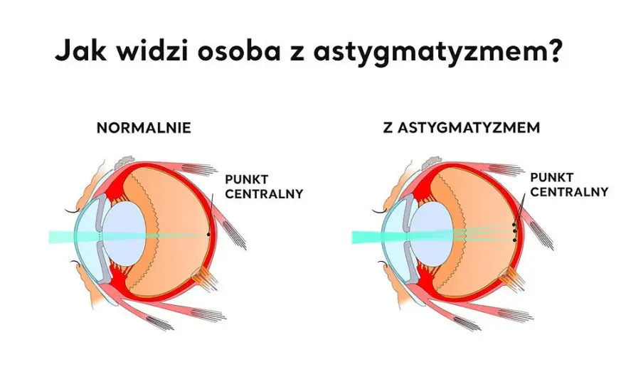 Jakie są wady wzroku? Poznaj objawy i skuteczne leczenie