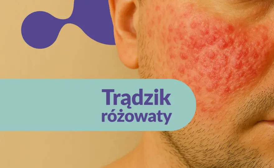 Rozex krem opinie - kiedy działa, a kiedy trzeba wrócić do lekarza