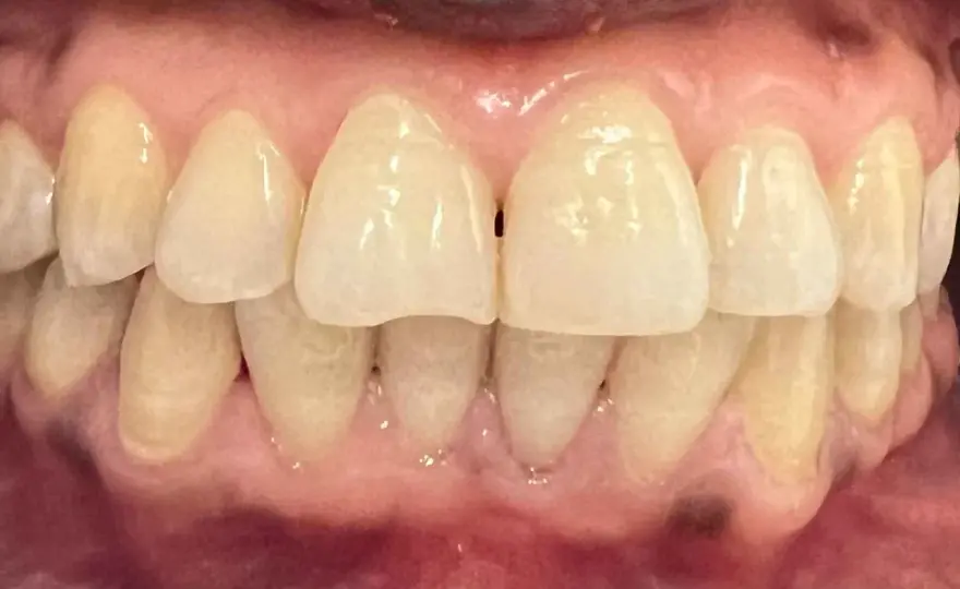Mancha en la encía ¿cuándo consultar al dentista?