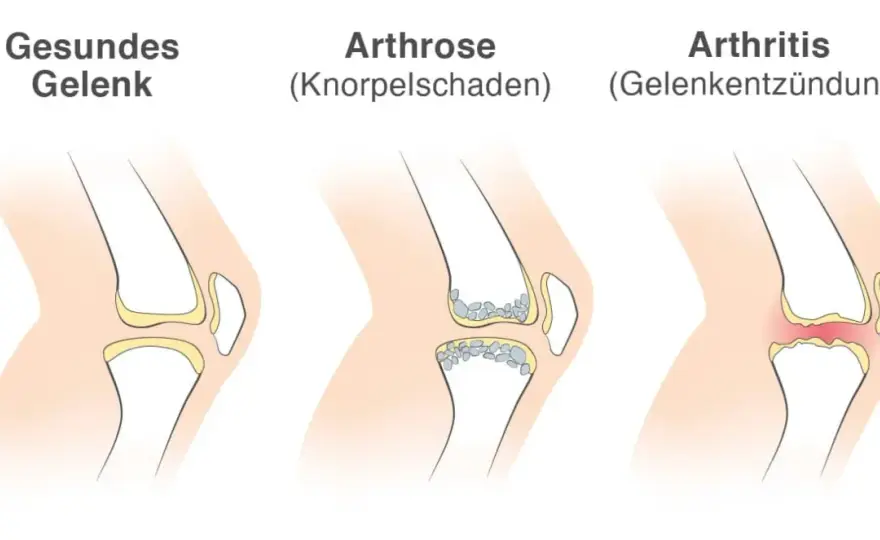 Arthritis erkennen - Formen, Symptome und was wirklich hilft