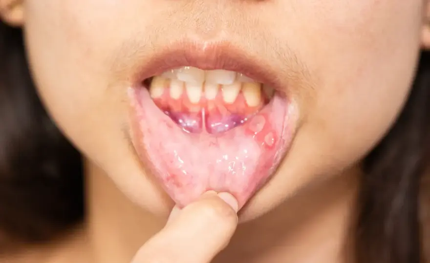Leukoplakia w jamie ustnej - kiedy biała plama jest groźna?