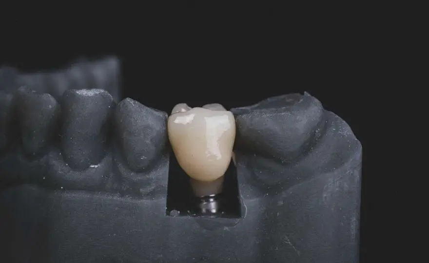 Impianti dentali nella mandibola - soluzioni, tempi e costi
