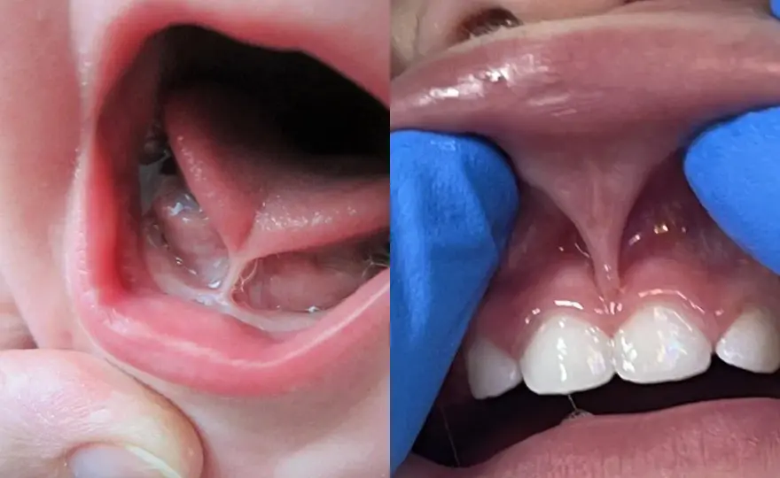 Frenectomía oral, cuándo se recomienda y cuánto cuesta