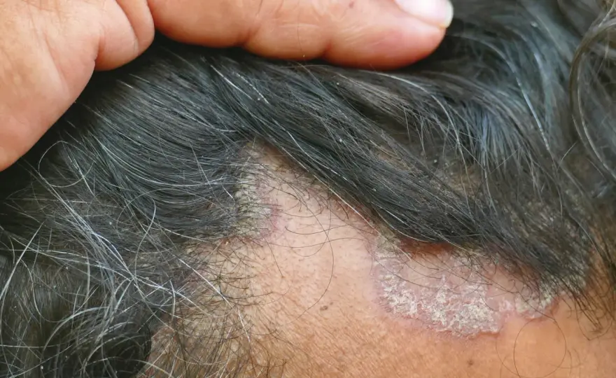 Schuppen im Haar: Ursachen, Behandlung & Hausmittel für gesunde Kopfhaut