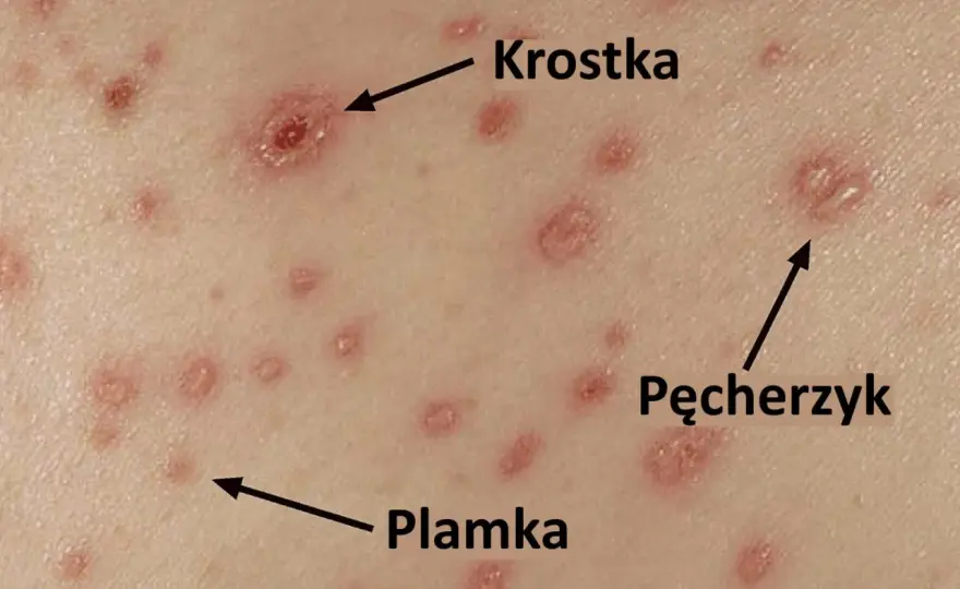 Ospa wietrzna - pierwsze objawy i co robić?